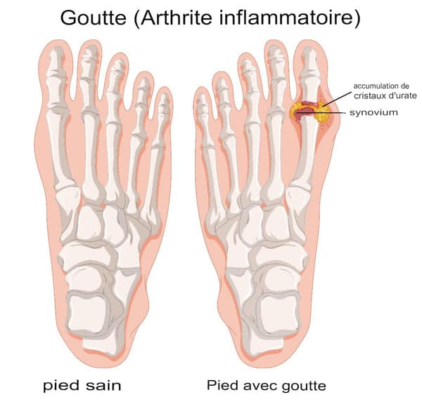 symptome goutte pied graphique