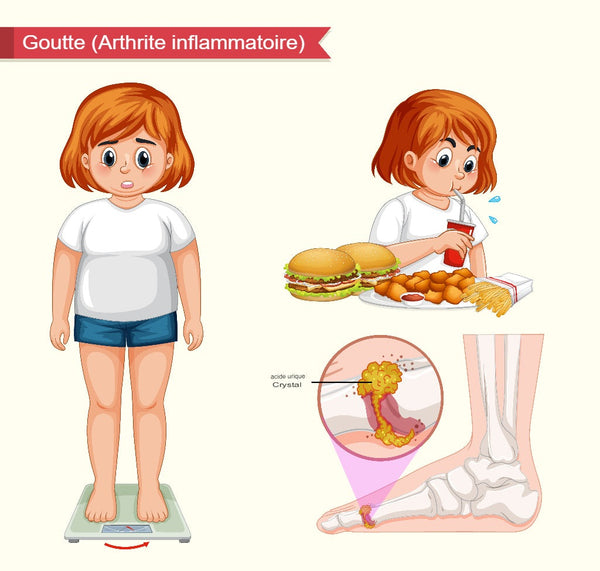 dessin d'une personne souffrant de goutte au pied à cause du poids et de l'alimentation